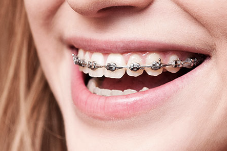 Traditional Braces